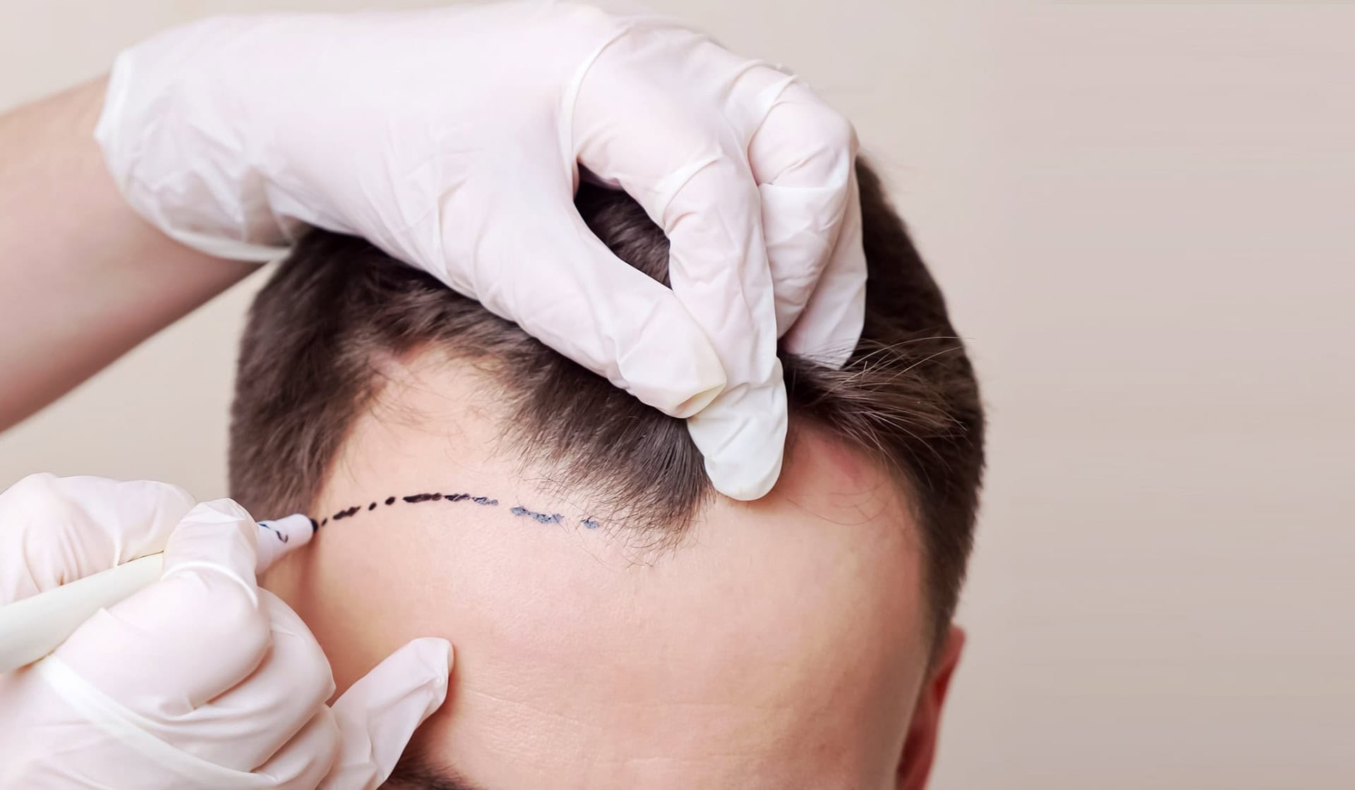 The Best Hair Transplant Surgeons In Turkey: 2026 Edition